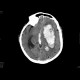 Intracerebral hemorhage, artifact from malfunctioning detector: CT - Computed tomography
